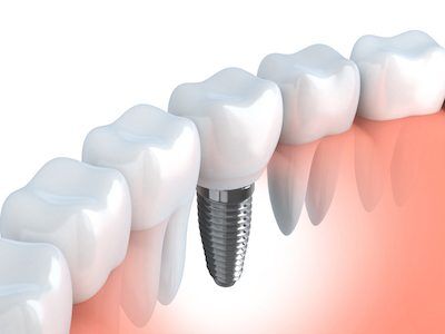 dental implants in Aurora, IL