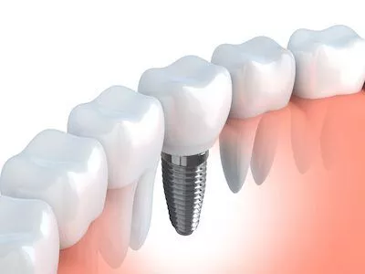 dental implants in Aurora, IL